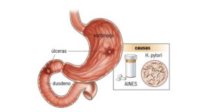 Úlcera Gástrica (estômago): sintomas e tratamento