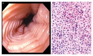 endoscopia esofagite eosinofilica