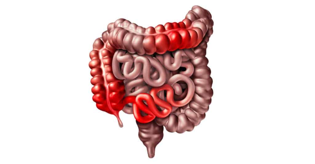 doença de Crohn